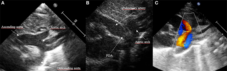 Patent Ductus Arteriosus Echo