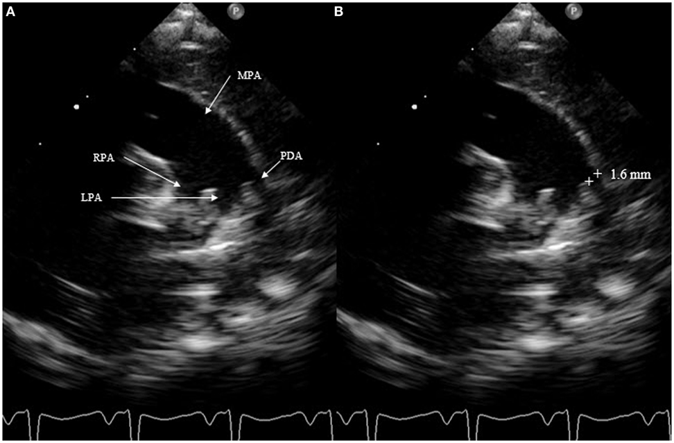 Patent Ductus Arteriosus Echo