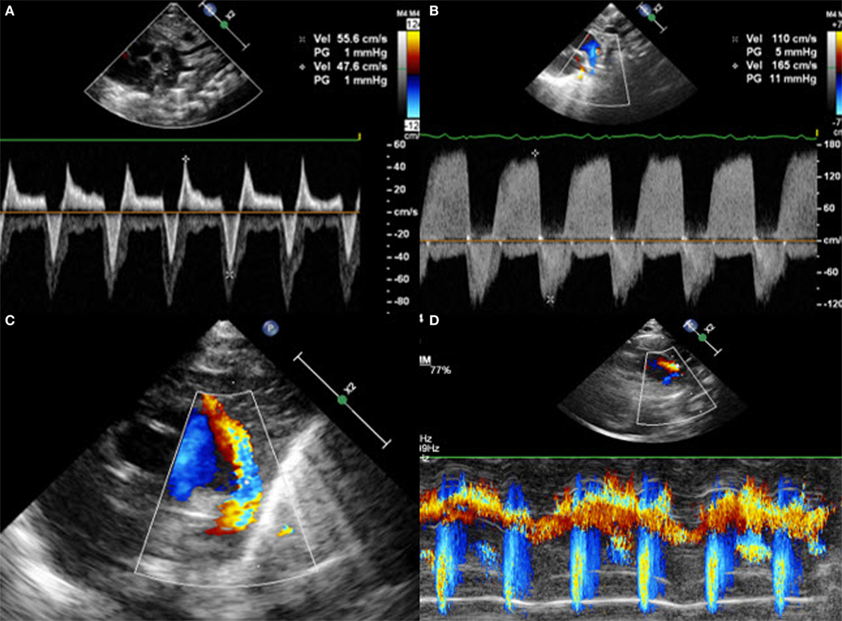 Patent Ductus Arteriosus Echo