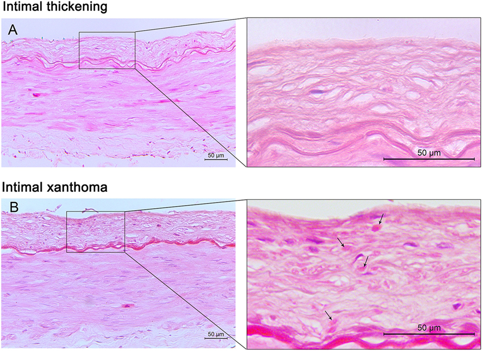 A Definition of Advanced Types of Atherosclerotic Lesions and a  Histological Classification of Atherosclerosis