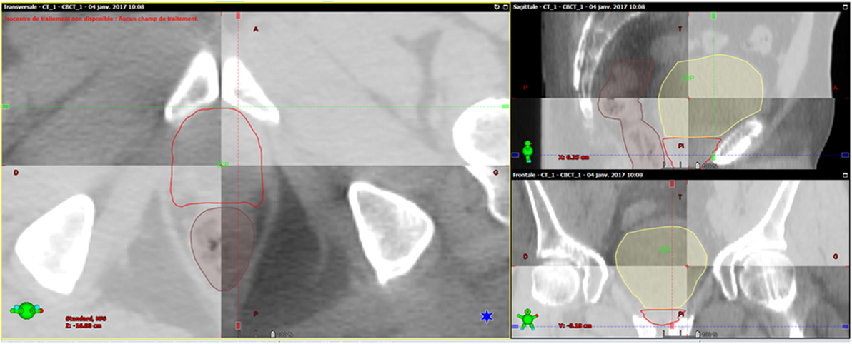 Igrt Prostate Cancer All About Radiation Igrt Prostate Cancer All About Radiation