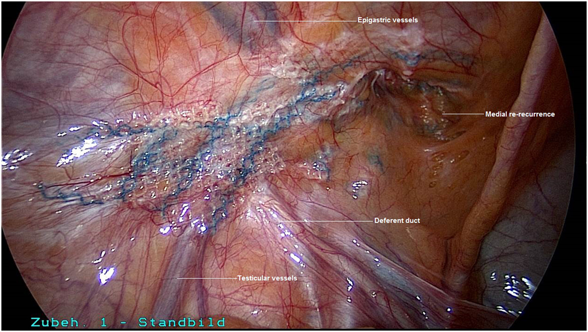 Inguinal hernia, Diagnosis, Treatment