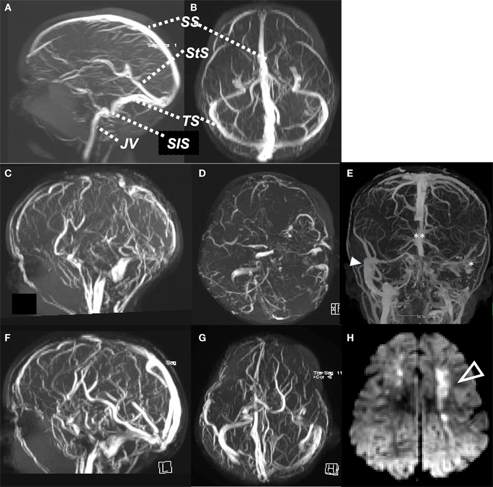 Superior cerebral veins - Wikipedia