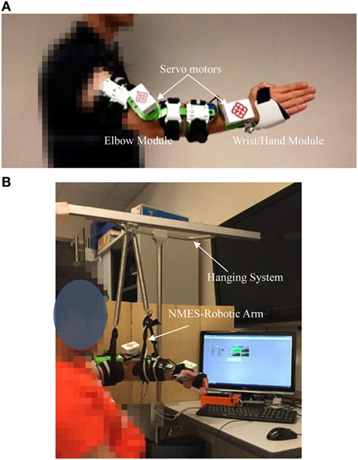 sEMG-triggered NMES unit and electrode placement