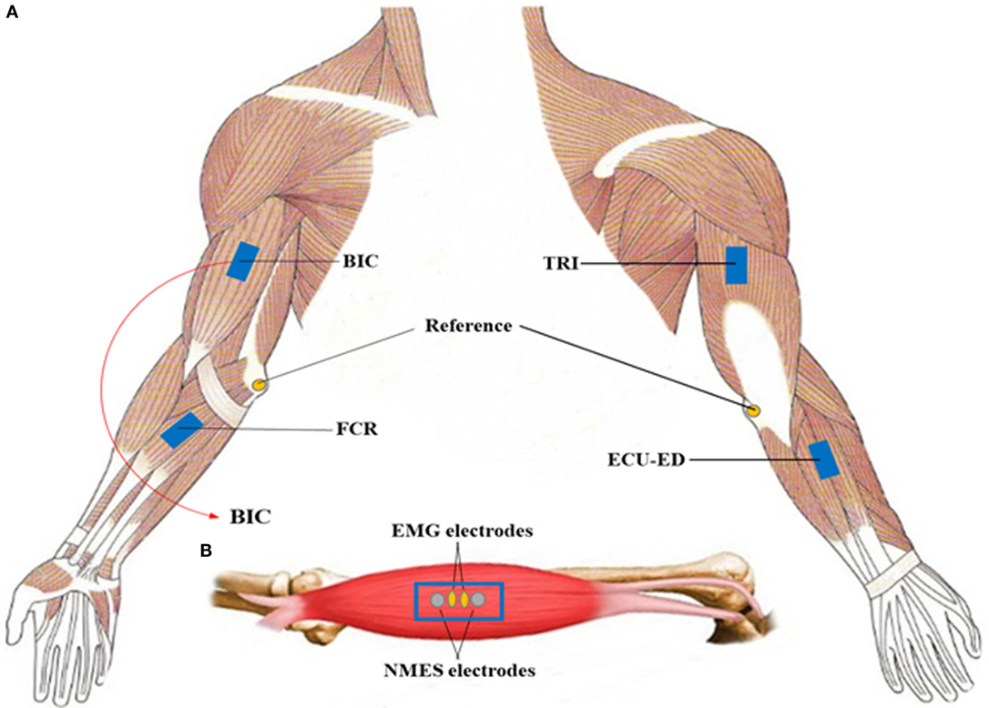 Stroke Rehabilitation: Use of electrical stimulation to help arm