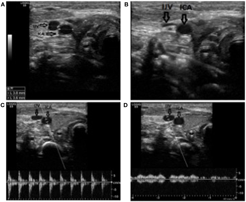 picc in innominate vein