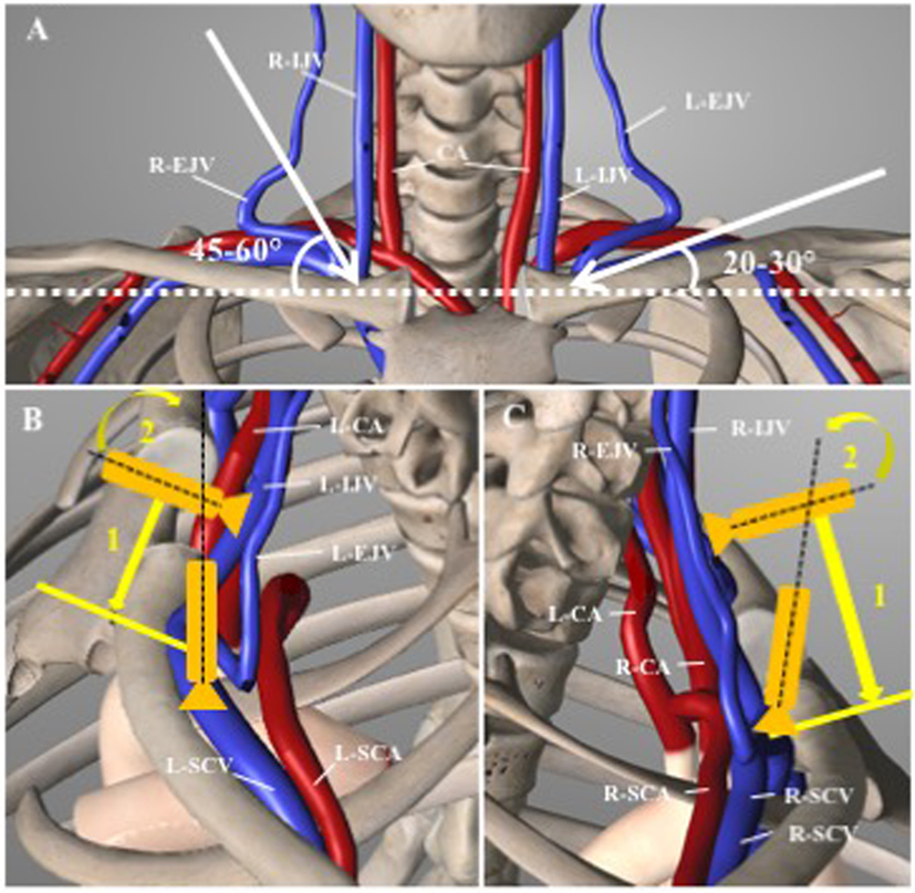 picc in innominate vein