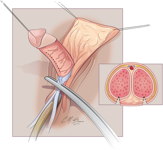 Vein above the clit