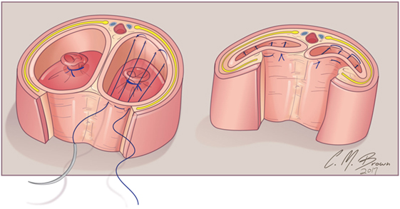 shrouded clitoris Surgery