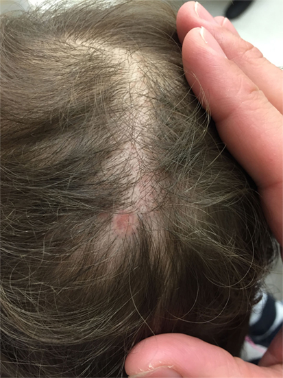 Frontiers | A Practical Approach to the Diagnosis and Management of Hair  Loss in Children and Adolescents
