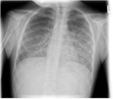 pneumonia pneumocystis ray chest pediatric frontiersin pediatrics jirovecii literature inflammatory bowel disease case report review bilateral demonstrating pulmonary infiltrates caused