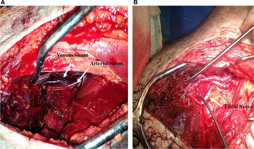 Frontiers  Vascular Shunts in Civilian Trauma