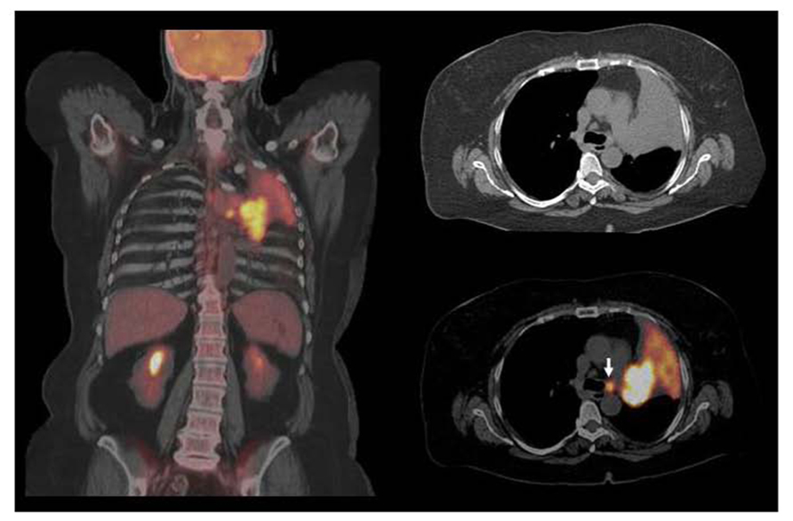 mesothelioma from asbestos exposure