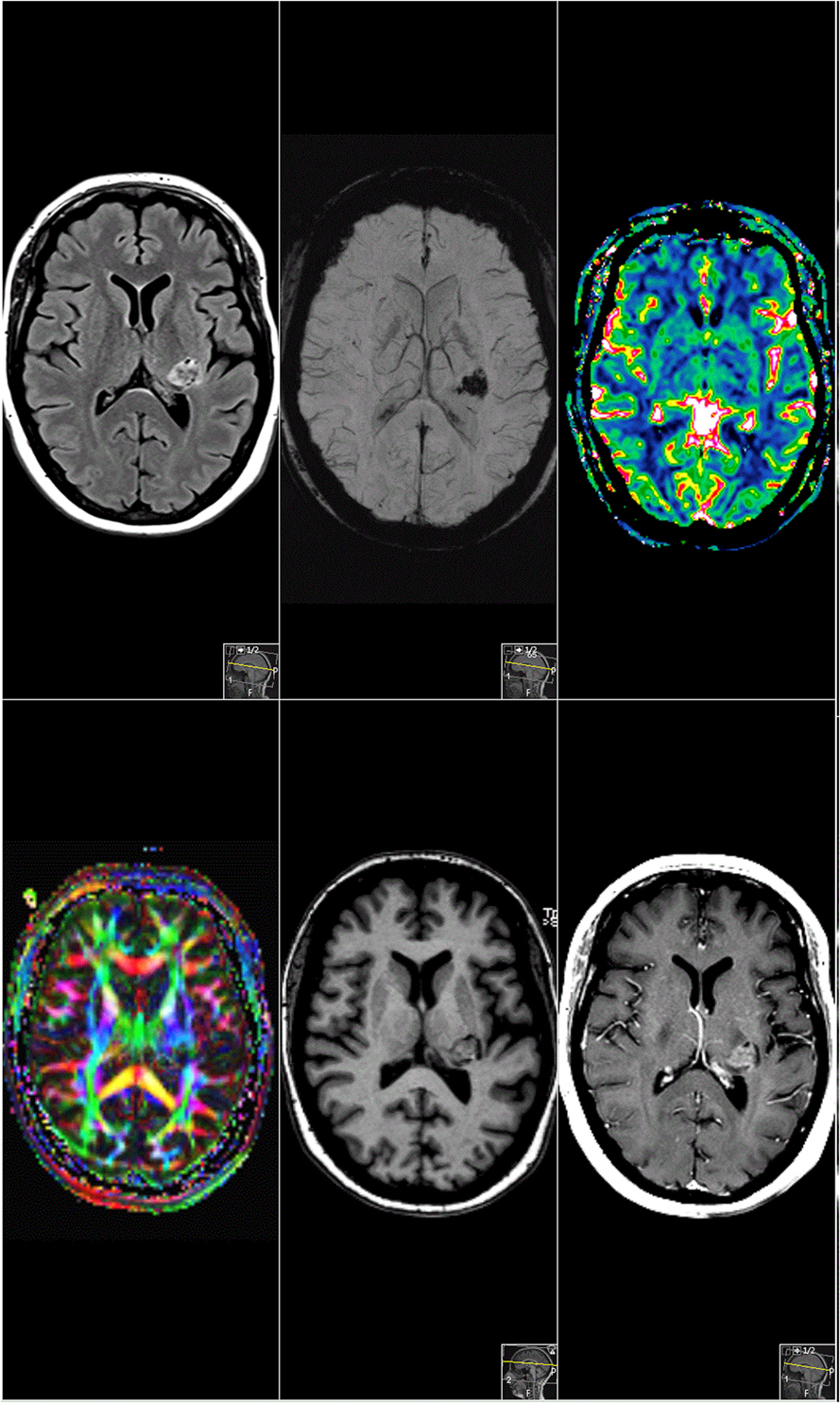 brain scan schizophrenia