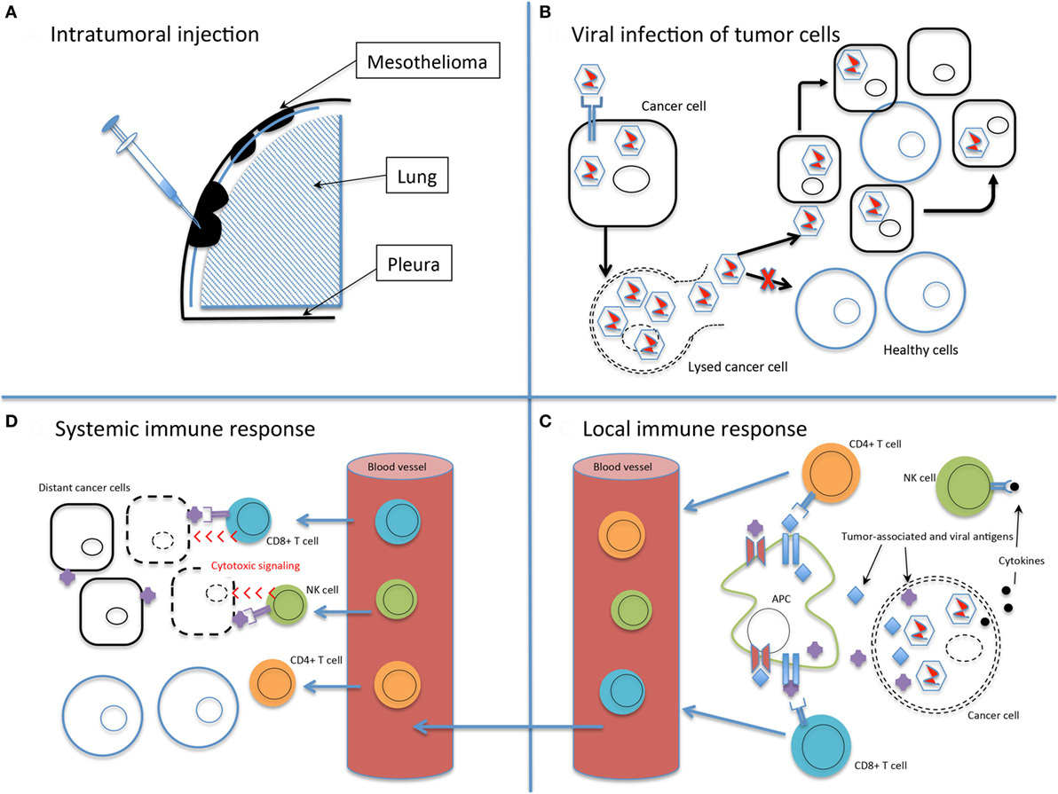 malignant pleural effusion review