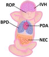 Figure 1 - This figure points to some important parts of a baby’s body that are injured when they are born early.