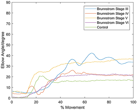 Brunnstrom Stages Of Recovery Chart Pdf