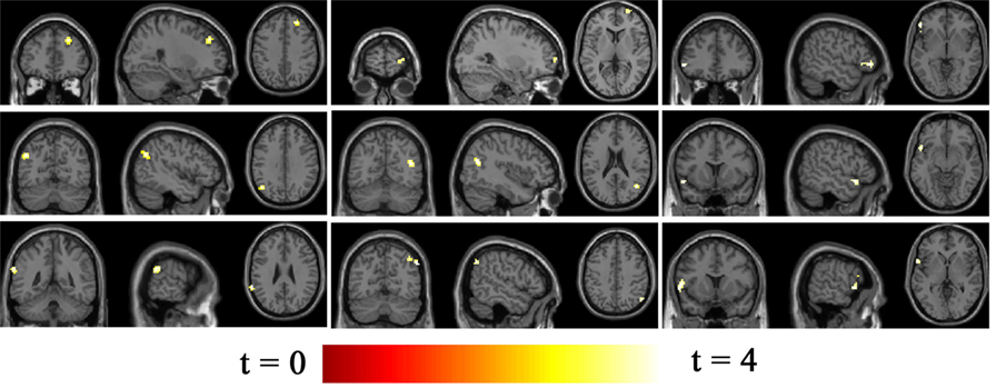 Frontiers | Altered Brain Functional Connectivity in Betel Quid 