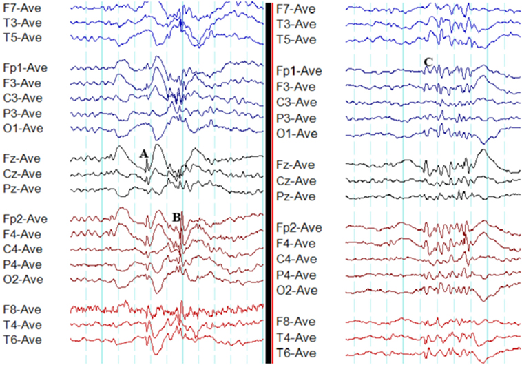 Maturation (Chapter 7) How To Read An EEG, 44% OFF