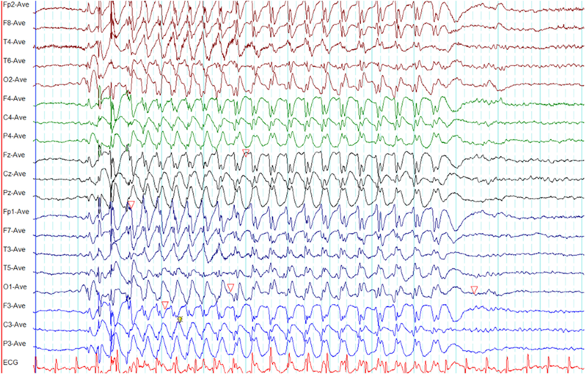 Generalized Seizure Eeg