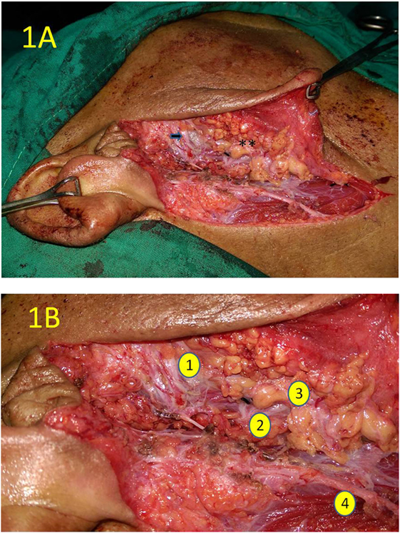 pleomorphic adenoma treatment surgery)