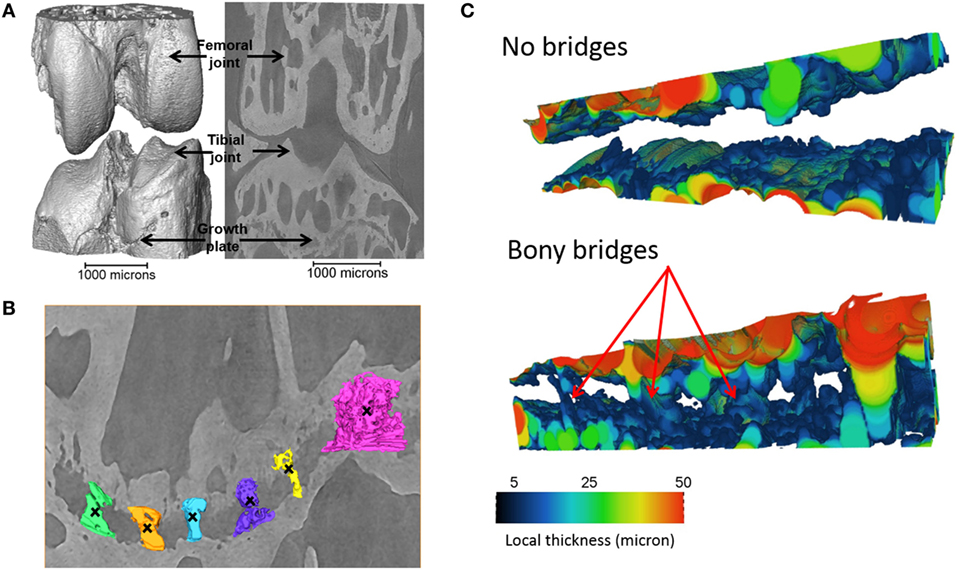 Development of a 3D Quantification Method for Growth Plate Bridging.
