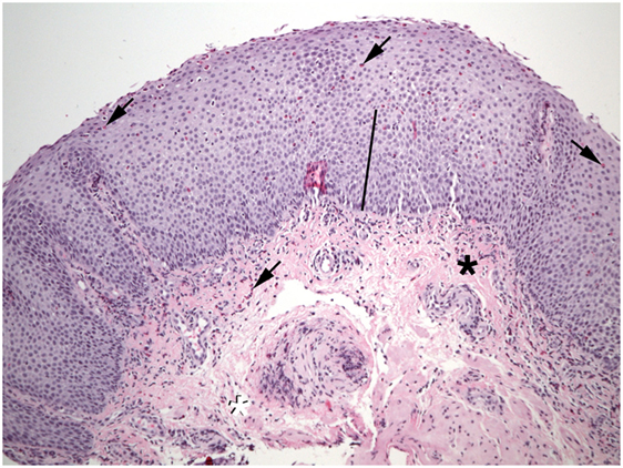 Frontiers Eosinophilic Gastrointestinal Disorders Pathology