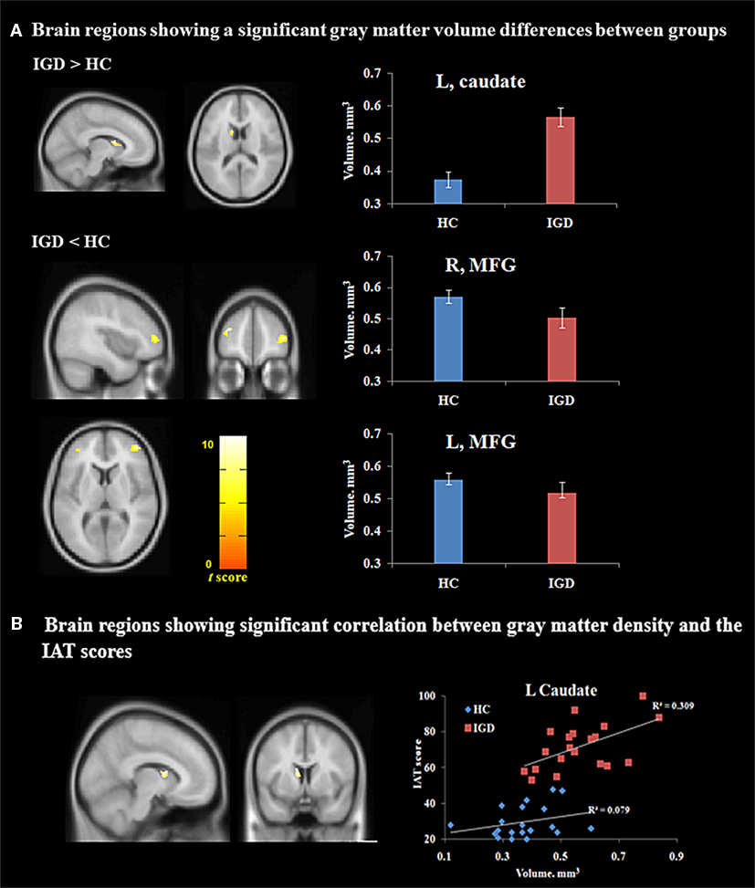 Playing Super Mario induces structural brain plasticity: gray matter  changes resulting from training with a commercial video game