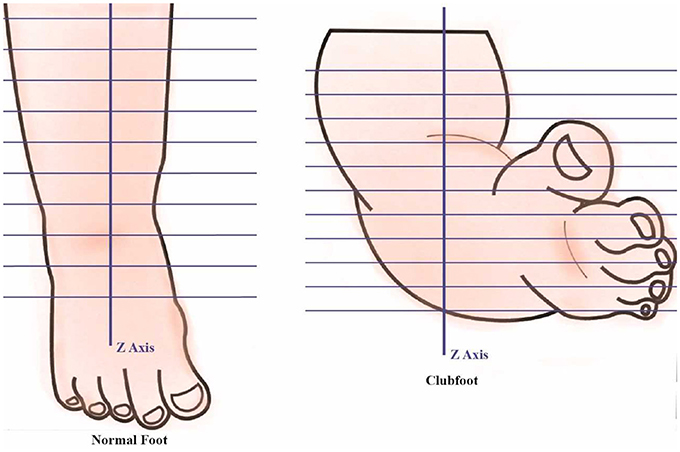 Frontiers Developing A Three Dimensional 3d Assessment Method For Clubfoot A Study Protocol