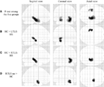Frontiers | Gray Matter and White Matter Abnormalities in Temporal Lobe ...