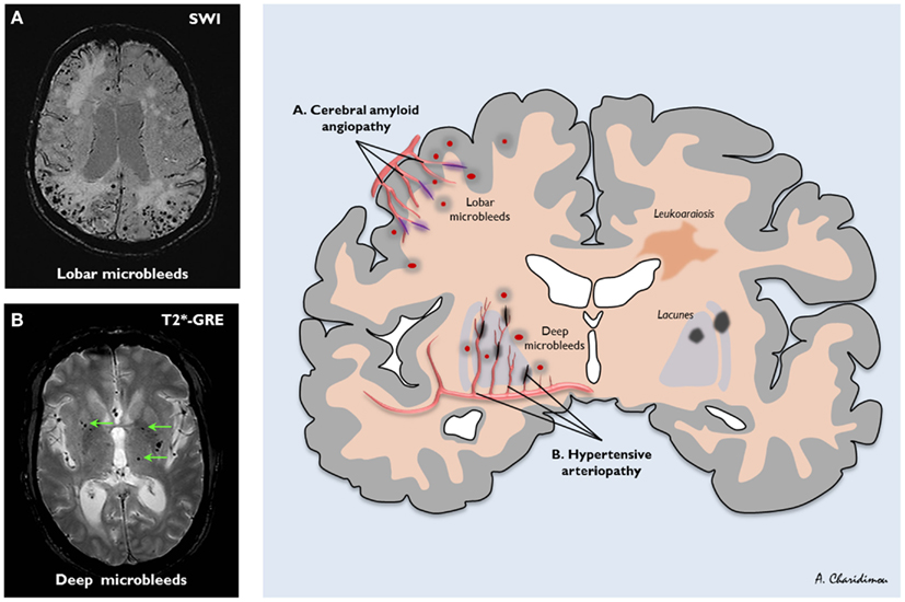 Frontiers | Cerebral Microbleeds on Magnetic Resonance Imaging and