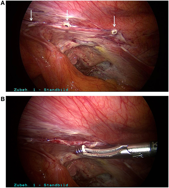 Inguinal Hernia, Top O.C Surgery Center