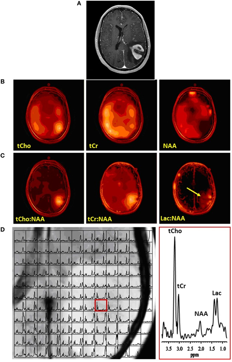 | Resonance Spectroscopy, Positron Emission Tomography and Radiogenomics—Relevance Glioma