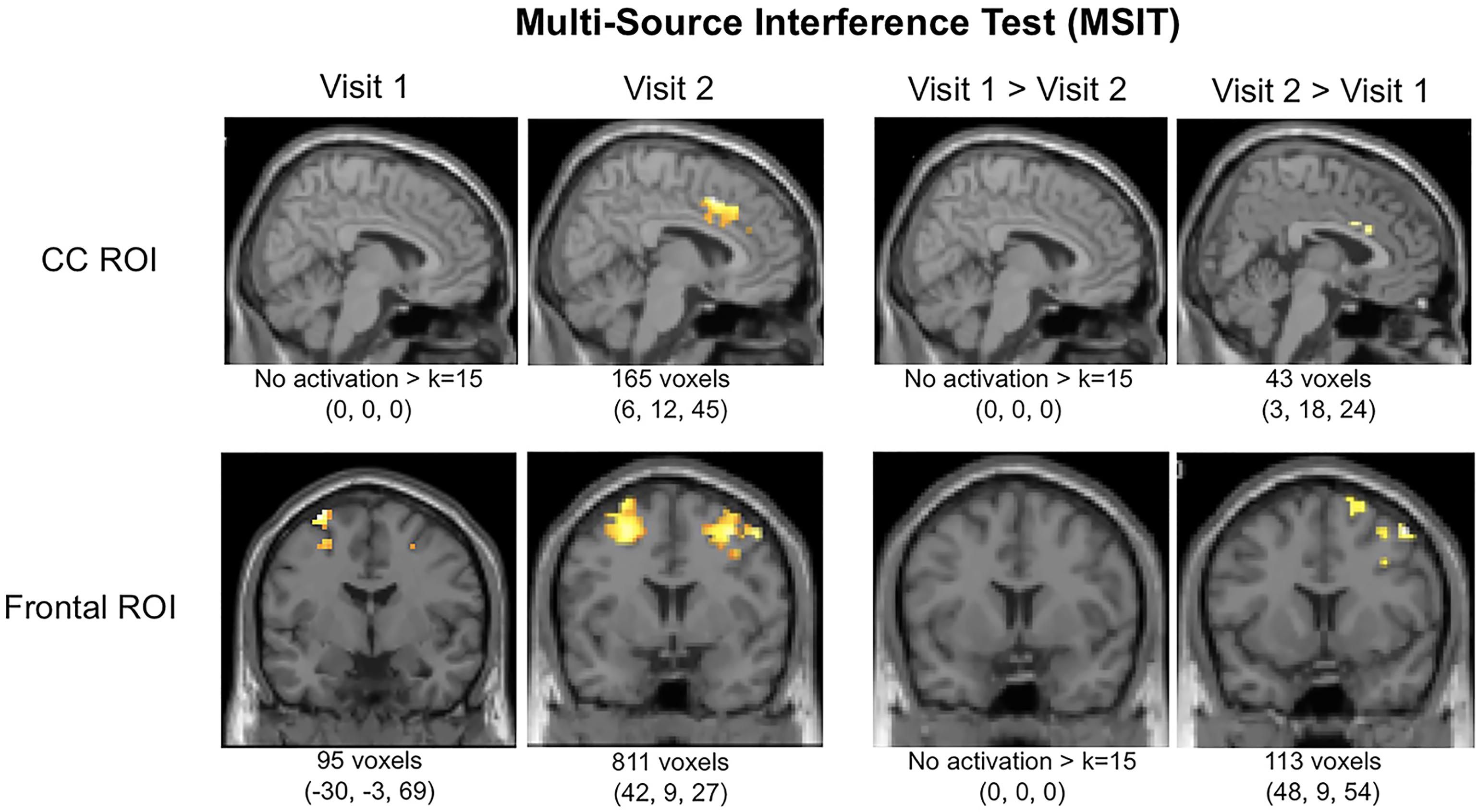 Altered brain structural and functional connectivity in cannabis users