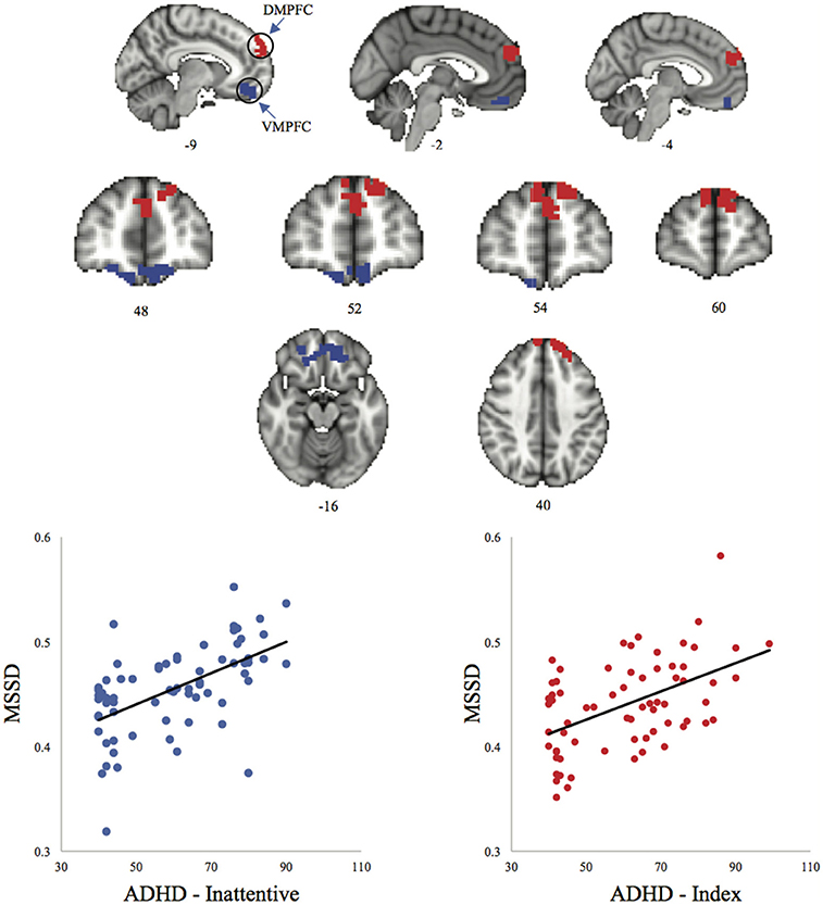 Increase In Adhd Mirrors Academic >> Frontiers Resting State Brain Signal Variability In Increase In Adhd Mirrors Academic >> Frontiers Resting State Brain Signal Variability In