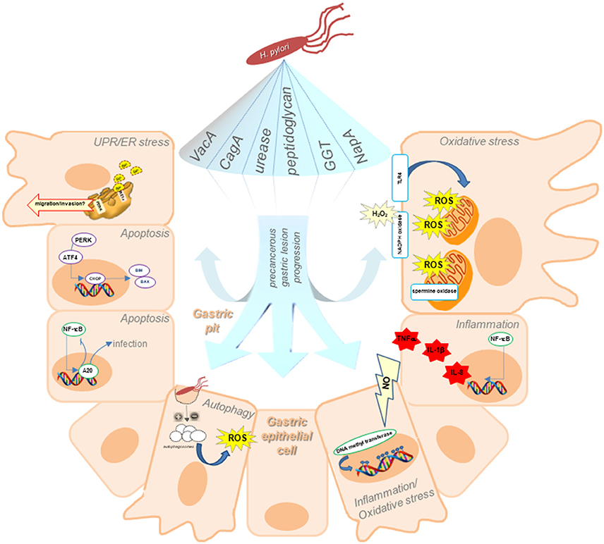 gastric cancer of progression