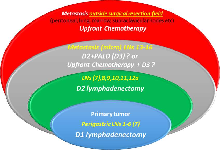 gastric cancer lymph node dissection pregătirea verucilor plantare