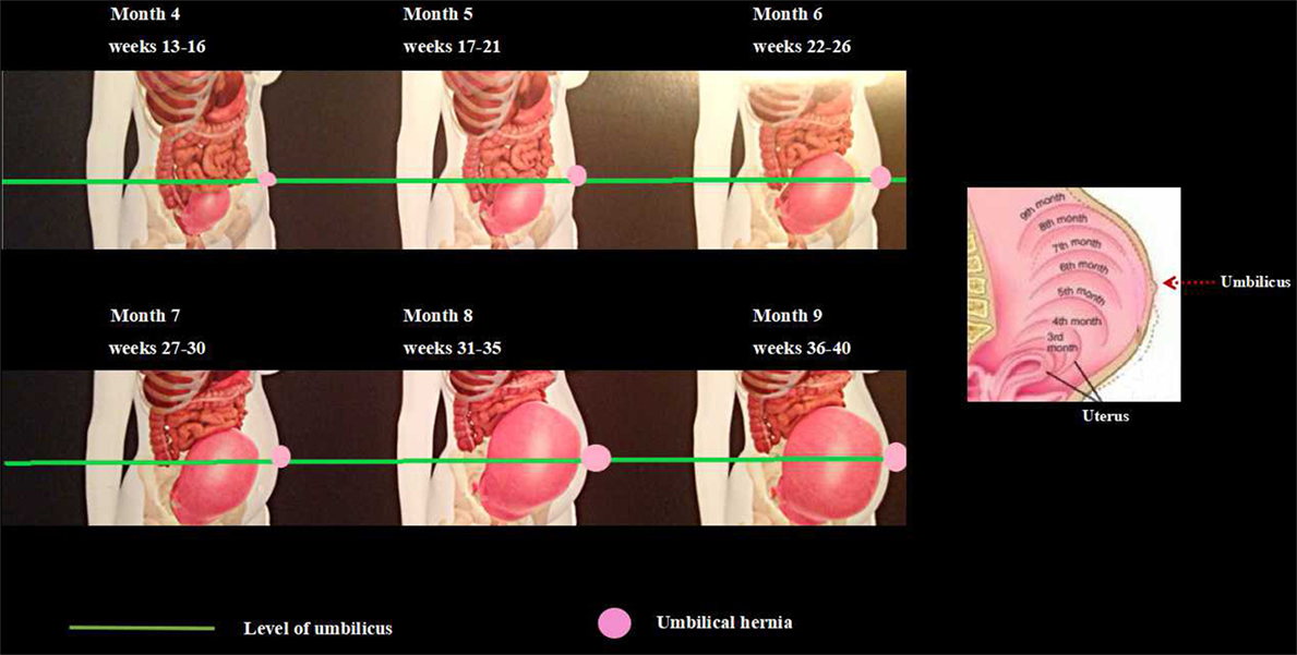 Umbilical hernia: What is it, symptoms and repair