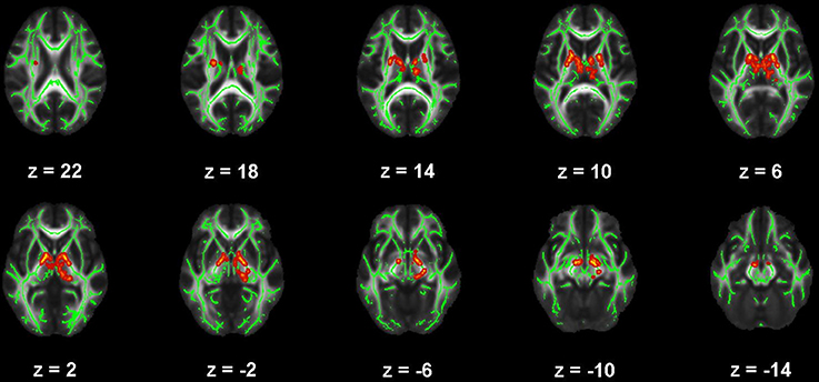 Diffusion Tensor Imaging in Traumatic Brain Injury