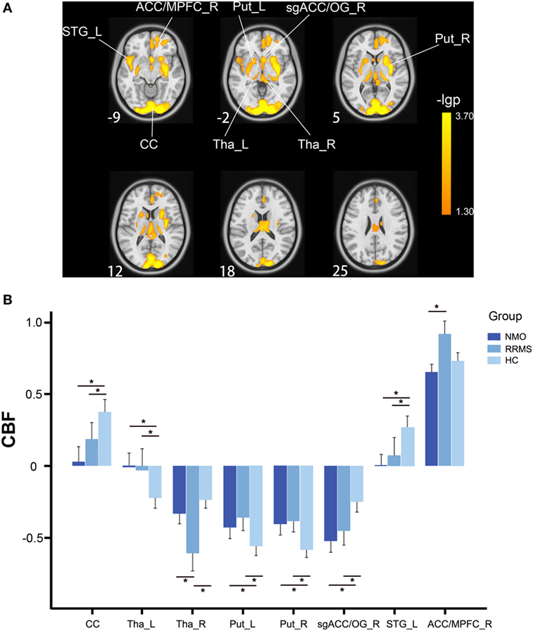 Imaging Surrogates of Disease Activity in Neuromyelitis Optica Allow  Distinction from Multiple Sclerosis