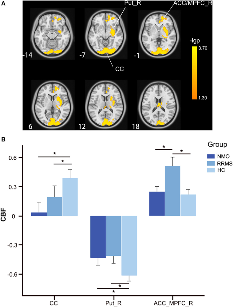 Imaging Surrogates of Disease Activity in Neuromyelitis Optica Allow  Distinction from Multiple Sclerosis