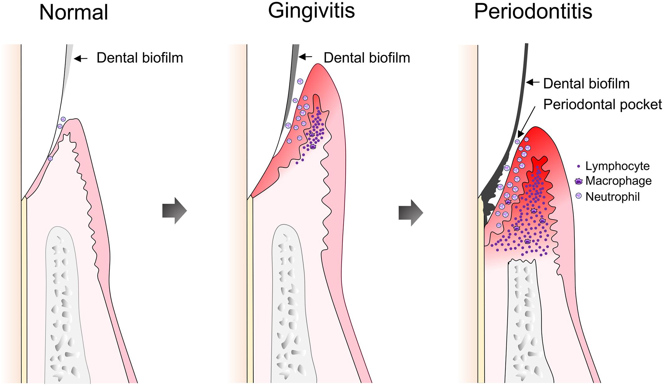 Frontiers | Oral Biofilms from Symbiotic to Pathogenic Interactions and