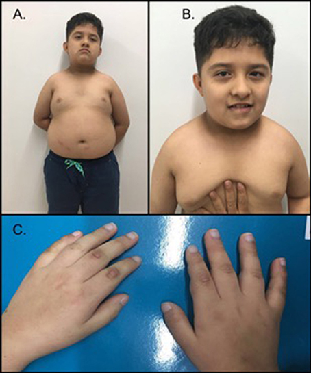 Frontiers | First Case Report of Prader–Willi-Like Syndrome in Colombia