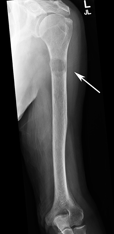 Bone Metastases Images and Xrays