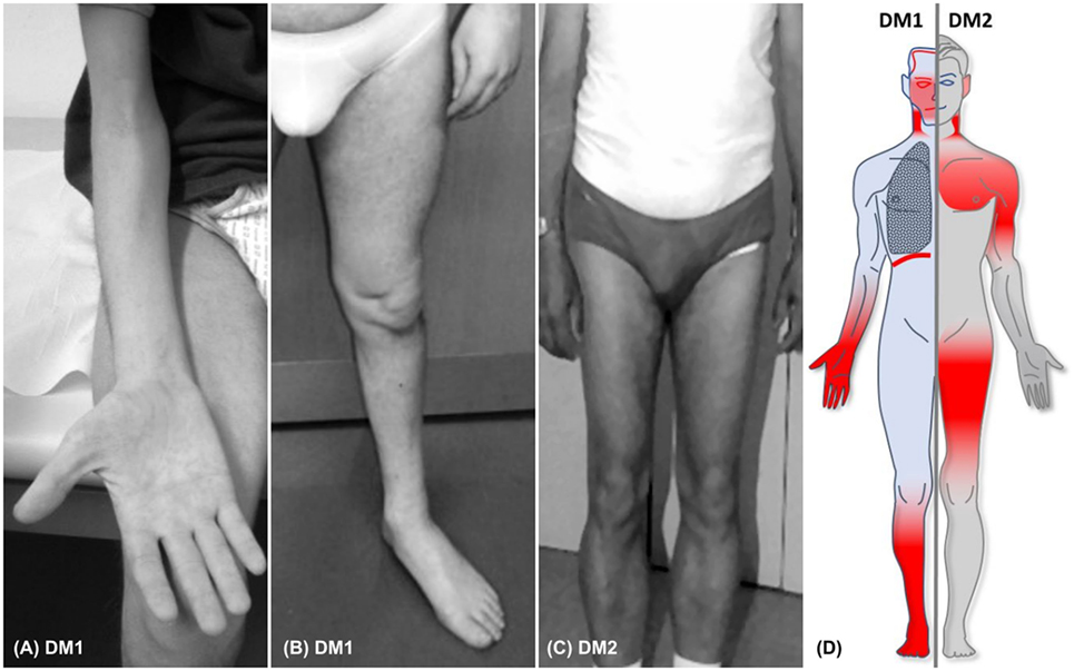 Frontiers | Core Clinical Phenotypes in Myotonic Dystrophies ...