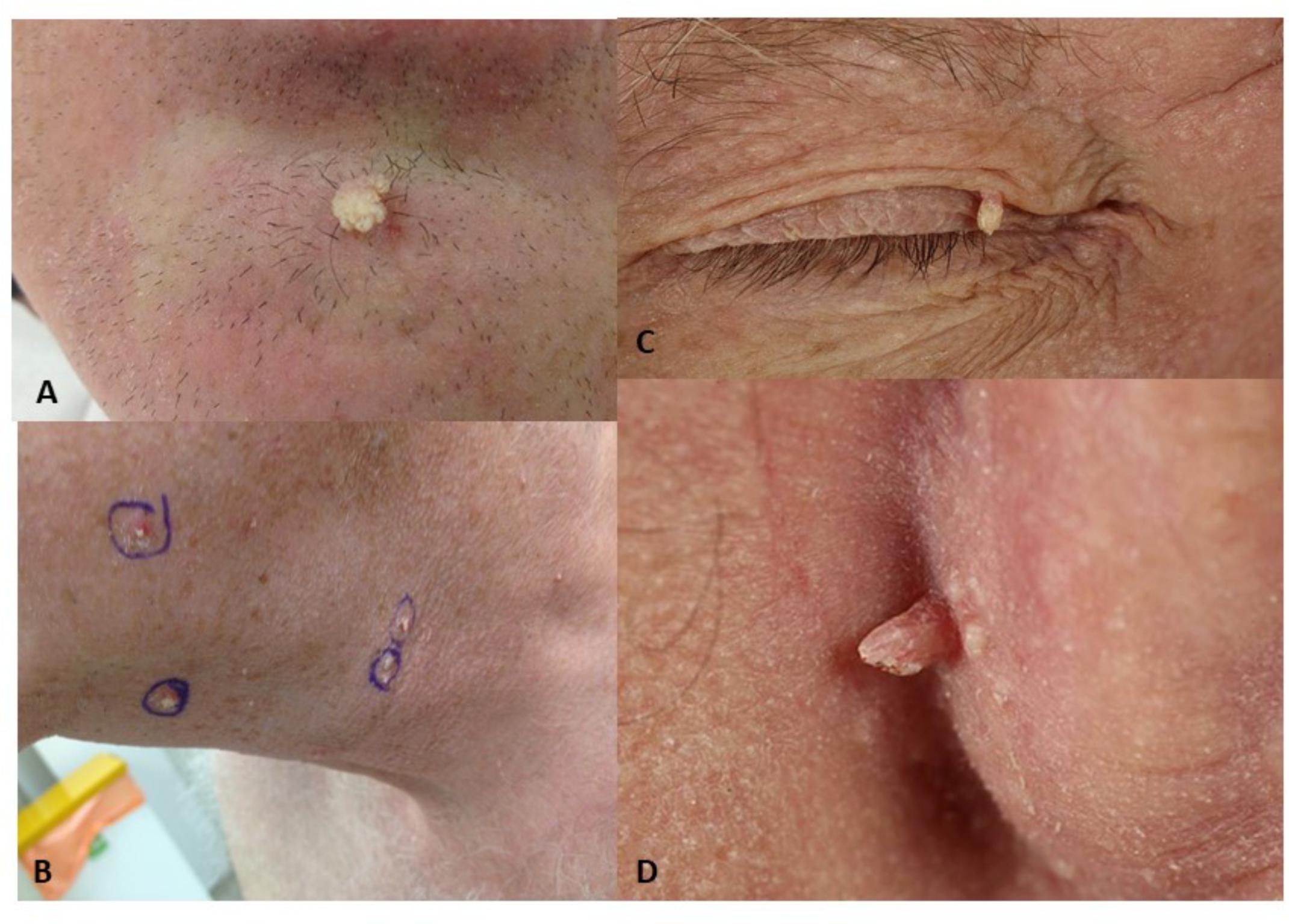 Papilloma vírus nhs