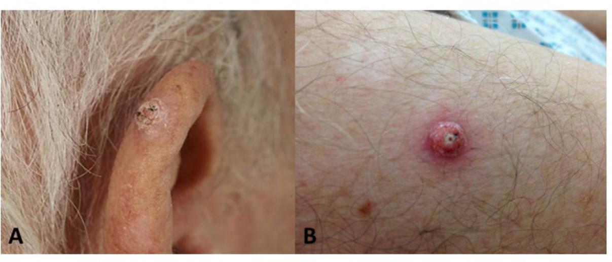 Papilloma like lesions. Papilloma like lesions