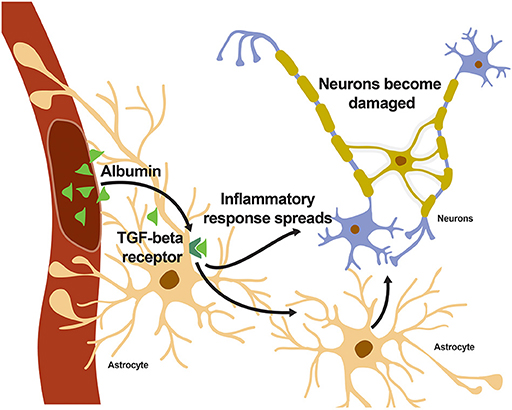 Figure 2 - When albumin enters the brain and binds to the TGF-β receptor on astrocytes, an inflammatory response spreads throughout the brain, eventually reaching the neurons.