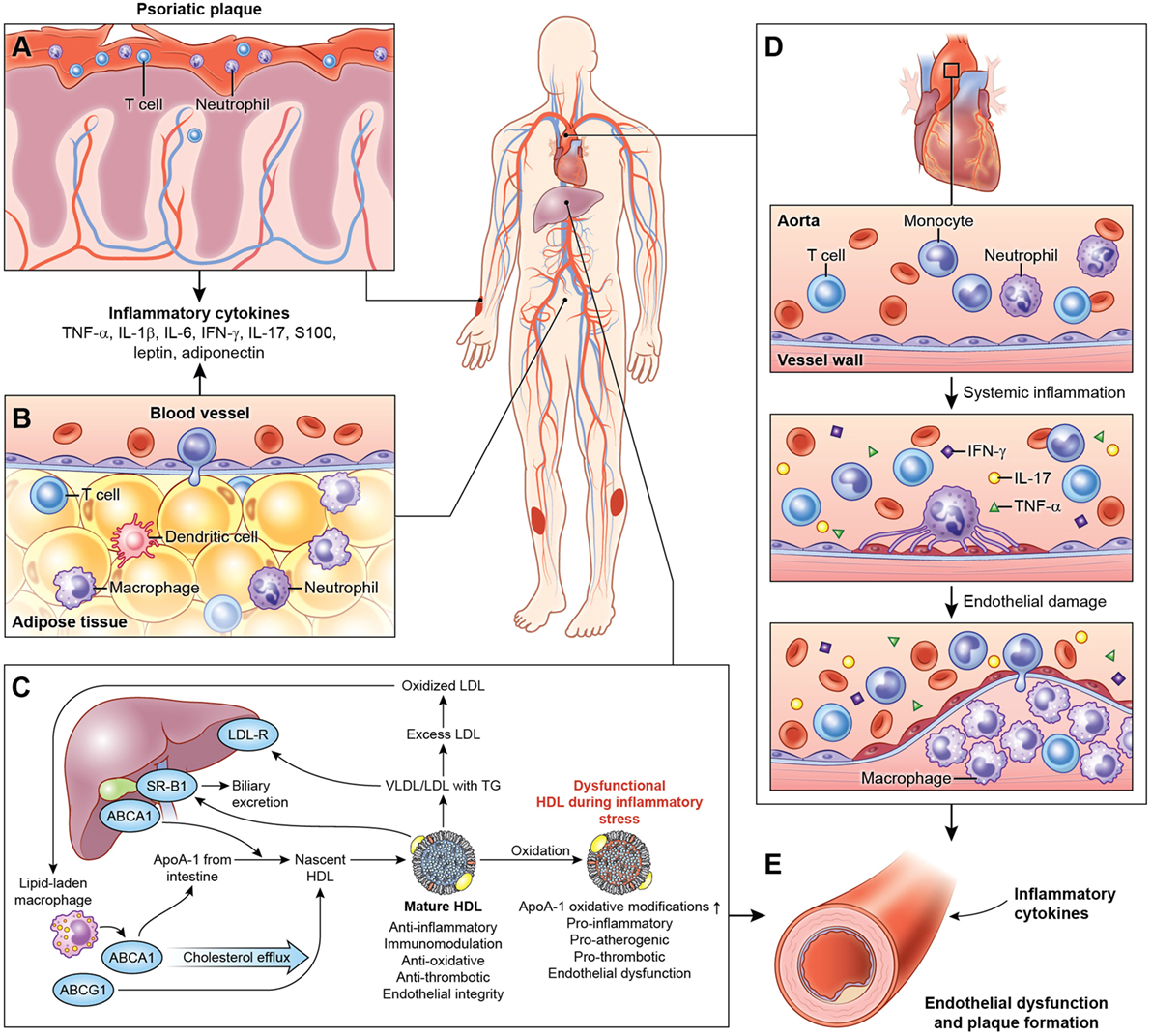 psoriasis coronary artery disease