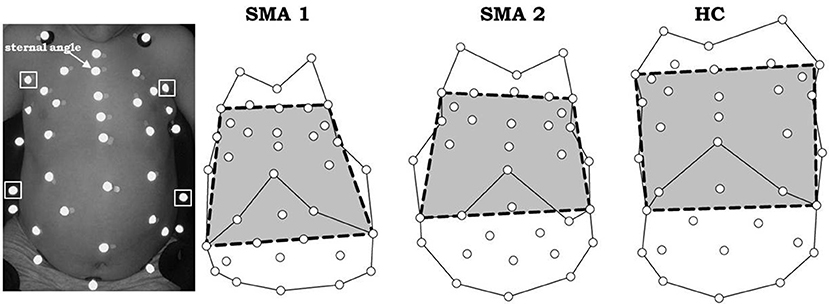 Frontiers  A New Method for Measuring Bell-Shaped Chest Induced